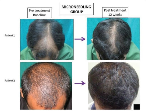 microneedling hair growth