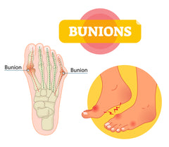 bunions foot pain misalignment