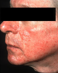 Rosacea - What are the causes?