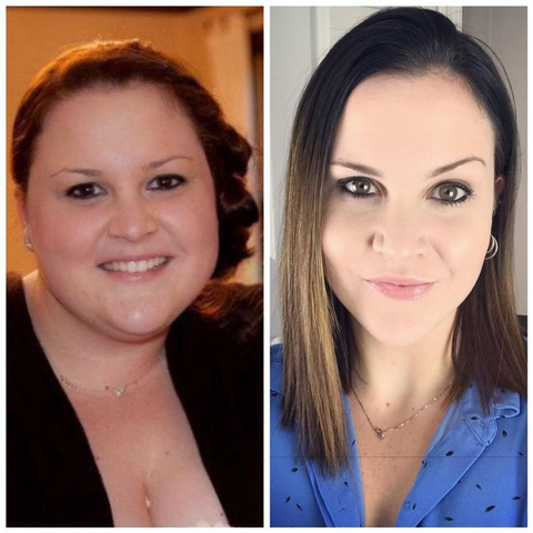 Kimberly H Before & After Gastric Sleeve