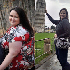 Kimberly Before & After Bariatric Surgery