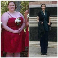 Gastric Bypass Before & After