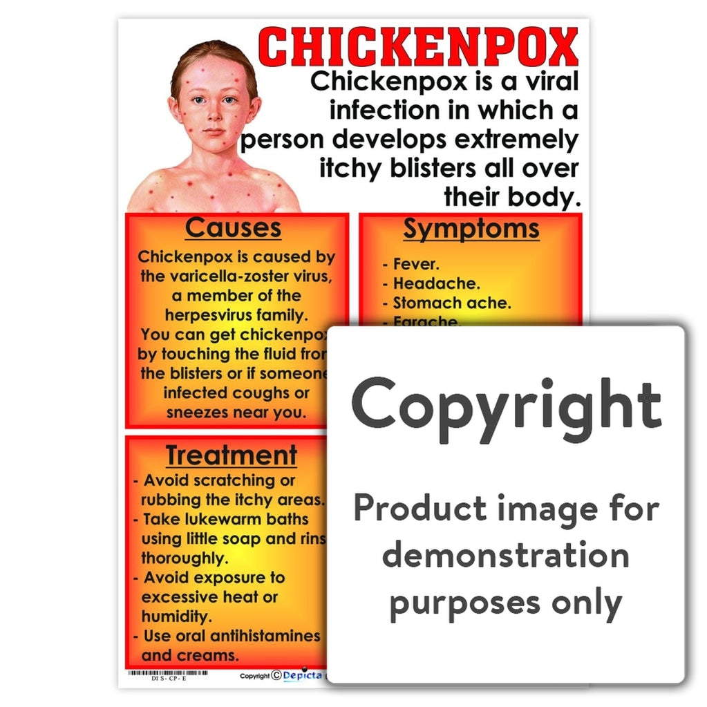 Chicken Pox Chart
