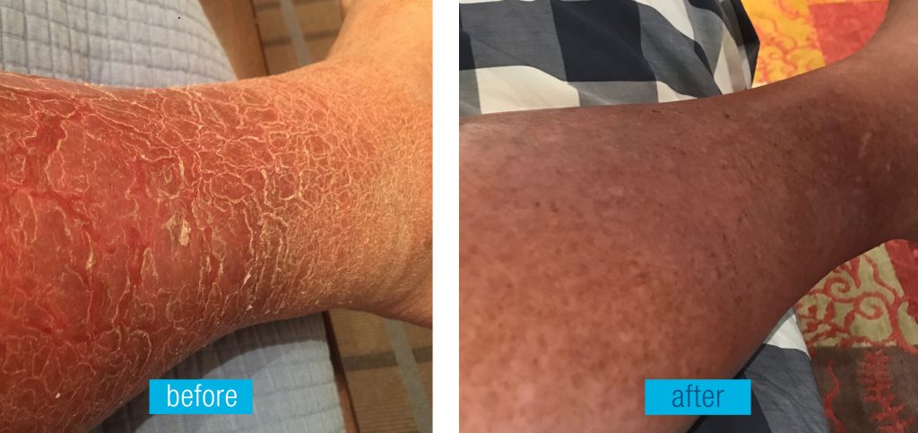 Dan's Skinfix Story