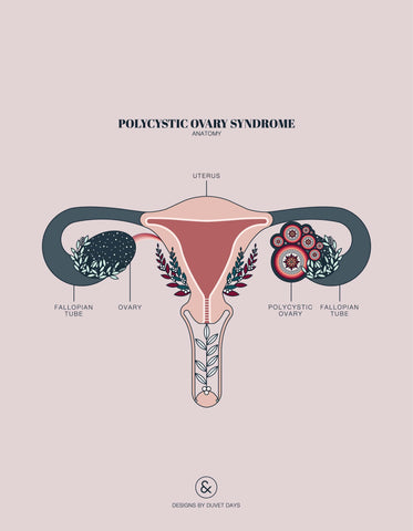 Illustration of PCOS