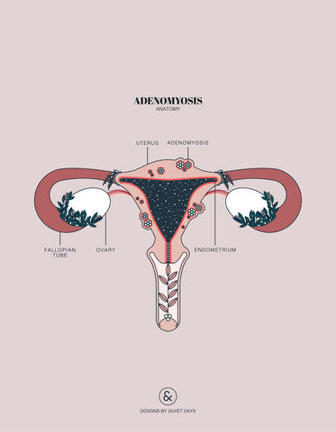 Illustration of adenomyosis