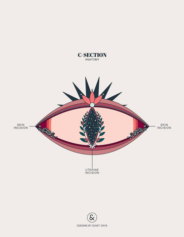 Illustration of a c-section