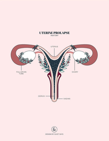 Illustration of a prolapsed uterus