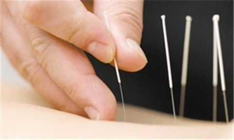 acupuncture treatments