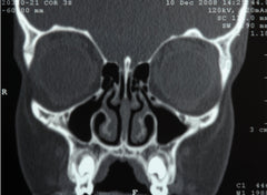 Xray of healthy sinus cavities full of air