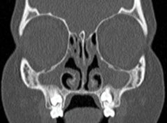 Xray of maxillary (cheek) sinuses without air