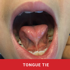 Child's mouth showing tongue tie