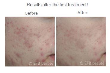 EFB-IPL-Acne-Treatment