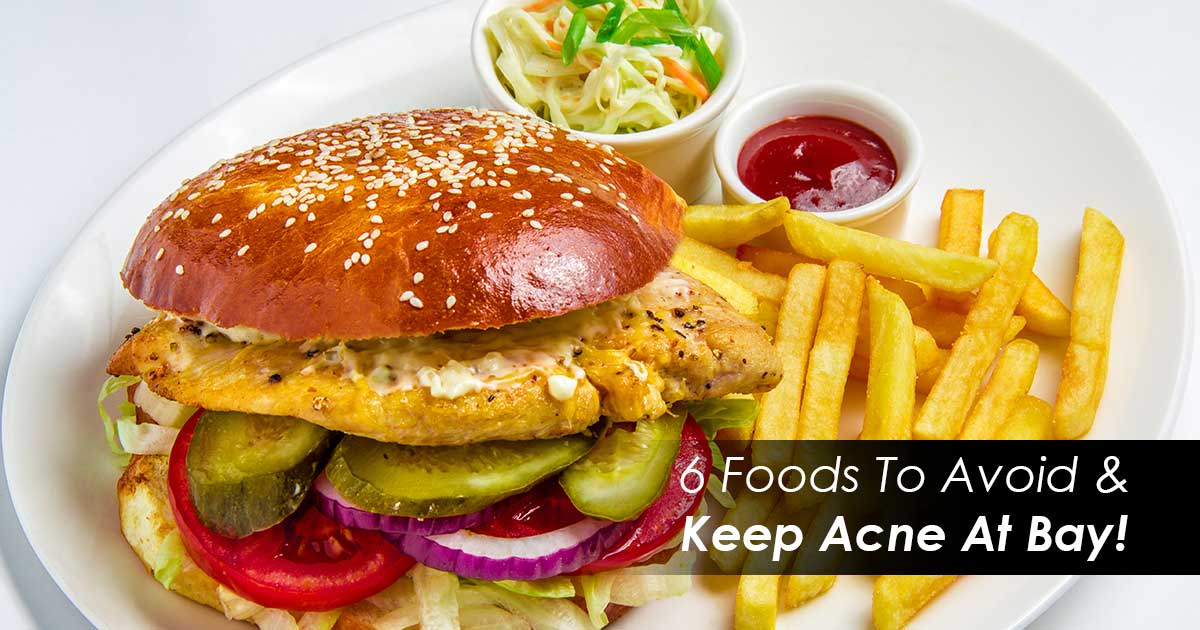 6 Foods To Avoid & Keep Acne At Bay