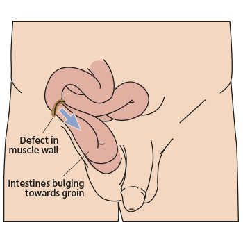 Hernia Explanation