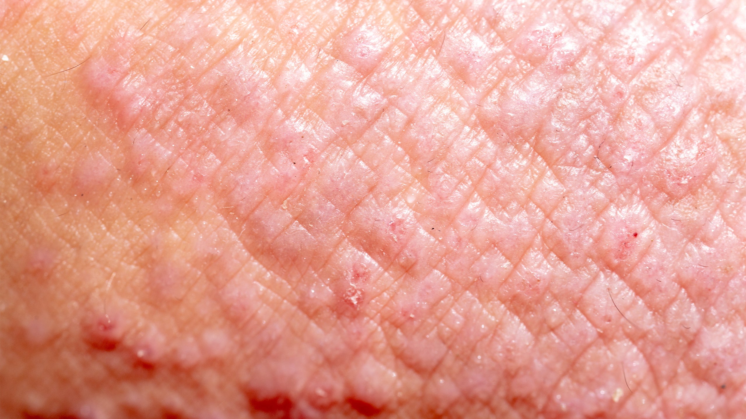 types-of-eczema-contact-dermatitis-gladskin