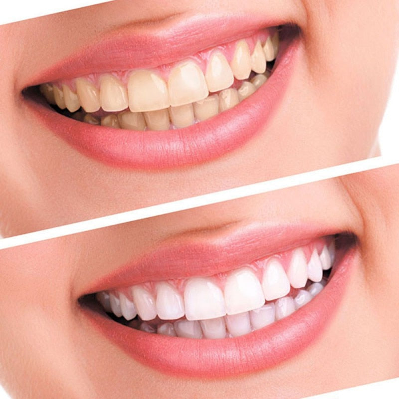 Resultado de imagen de blanqueamiento dental