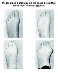 Assessment guide for Hallux valgus