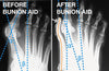 Bunion Treatment Splint