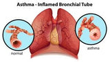 Sinus, Obstructive Pulmonary Diseases, Asthma And Emphysema 