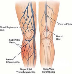 Superficial Thrombophlebitis