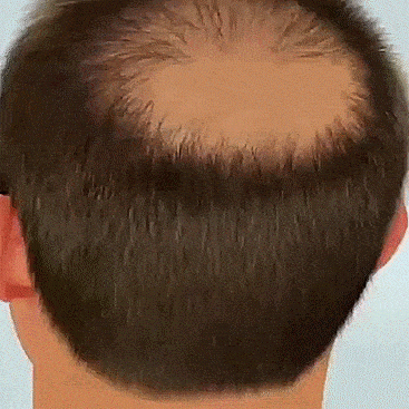 hair-loss-remedy