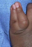 Syndactyly Fused Fingers Fingernails