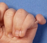 Syndactyly Fused Fingers Fingernails - Nail Snail
