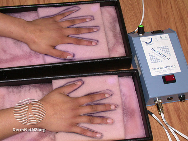 Iontophoresis for palmar hyperhidrosis