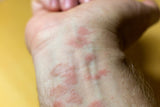 Eczema on wrist