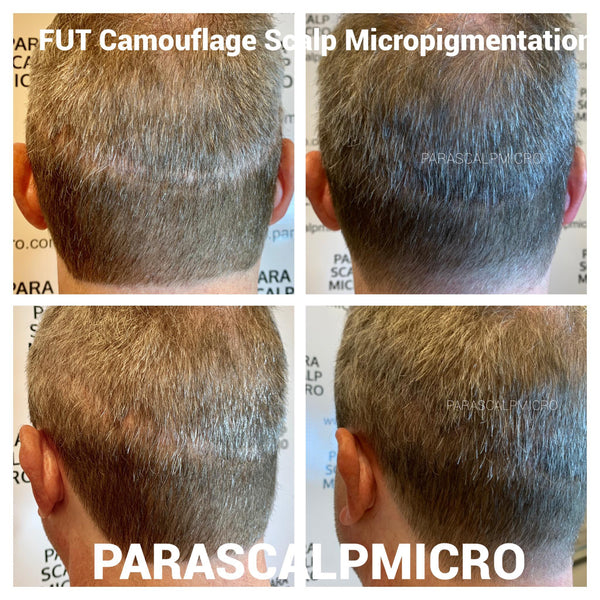 scalp micropigmentation smp hair tattoo fut fue scar camouflage density transplant clinic restoration best solution new york city NJ PA CT LI long island queens brooklyn manhattan 