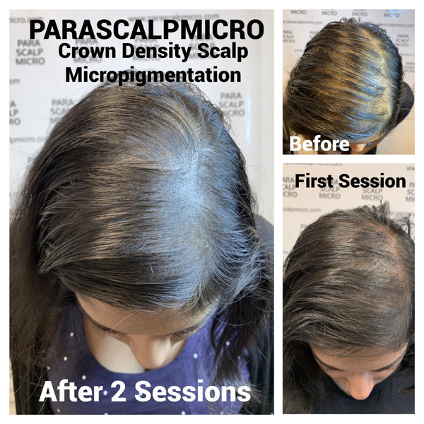 Female Hair Loss Alopecia Scalp Micropigmentation Hair Tattoo Crown Density NYC New York City NJ CT LI PA