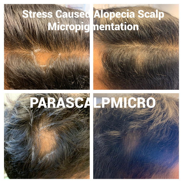 Stress Hair Loss Alopecia Scalp Micropigmentation Scar Camouflage Hair Therapy SMP Hair Tattoo NYC New York City NJ LI PA CT