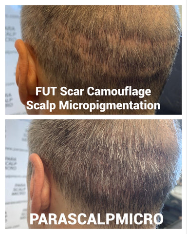 FUT FUE scar camouflage hair transplant scalp micropigmentation hair tattoo natural results new york city NJ PA CT long island brooklyn queens manhattan staten