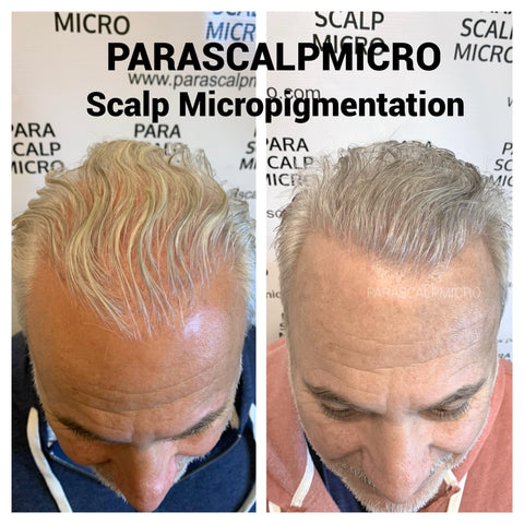 scalp micropigmentation tattoo alopecia hair loss transplant surgery FUE FUT density new york city