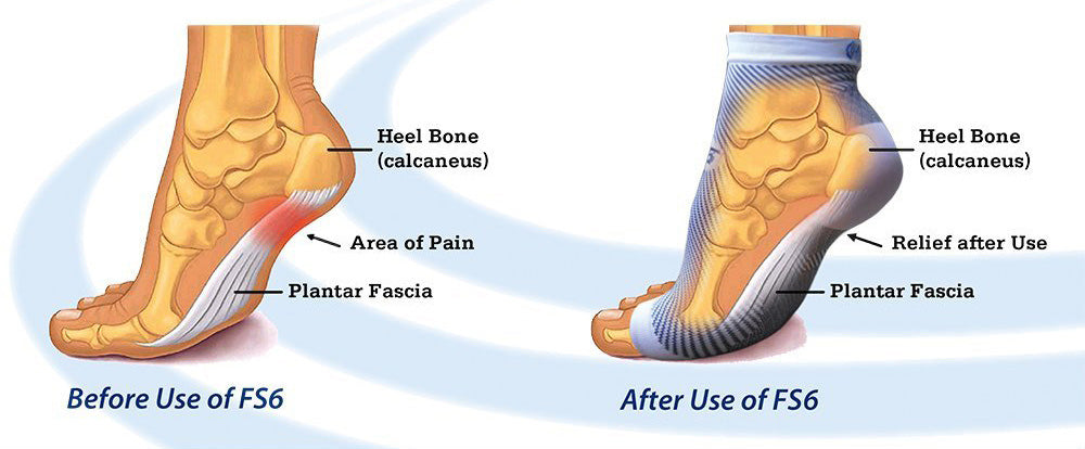 before and after fs6 planatar fasciitis