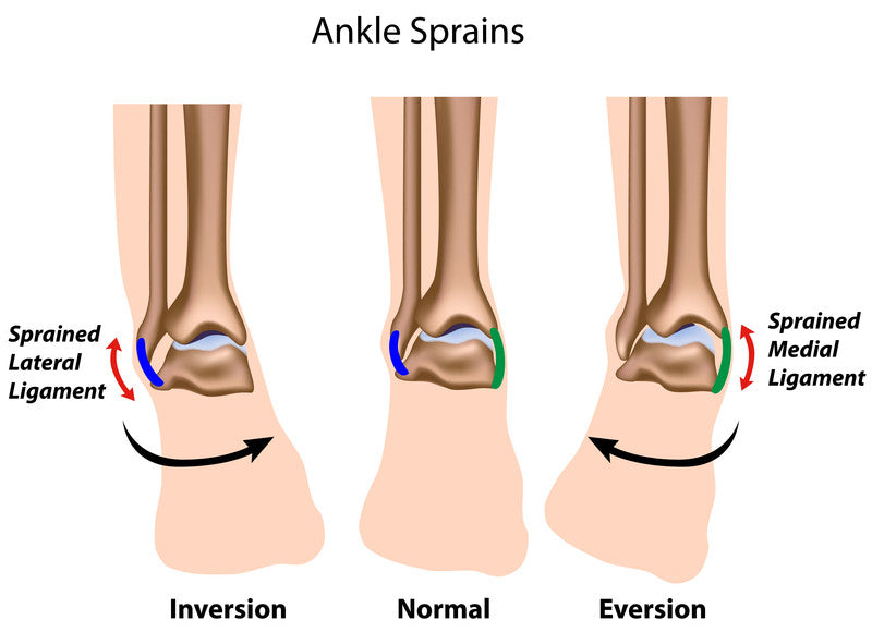 inversion eversion ankle sprain
