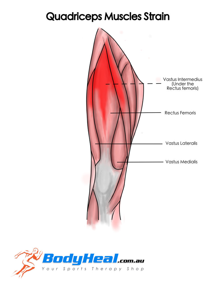 Quadriceps strain