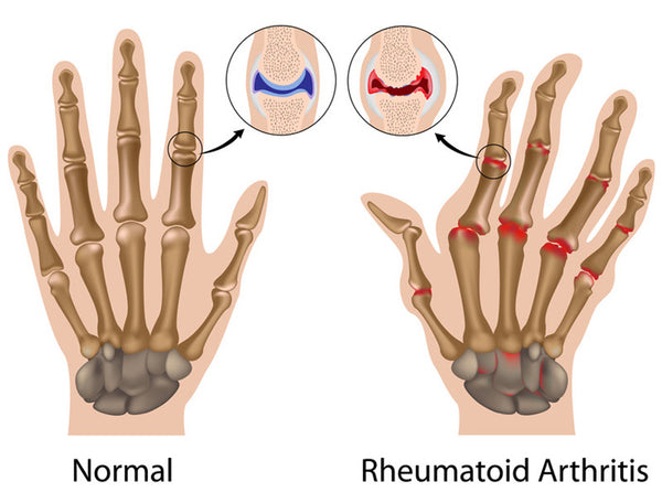 what is rheumatoid arthritis