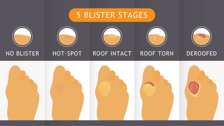 the five blister stages