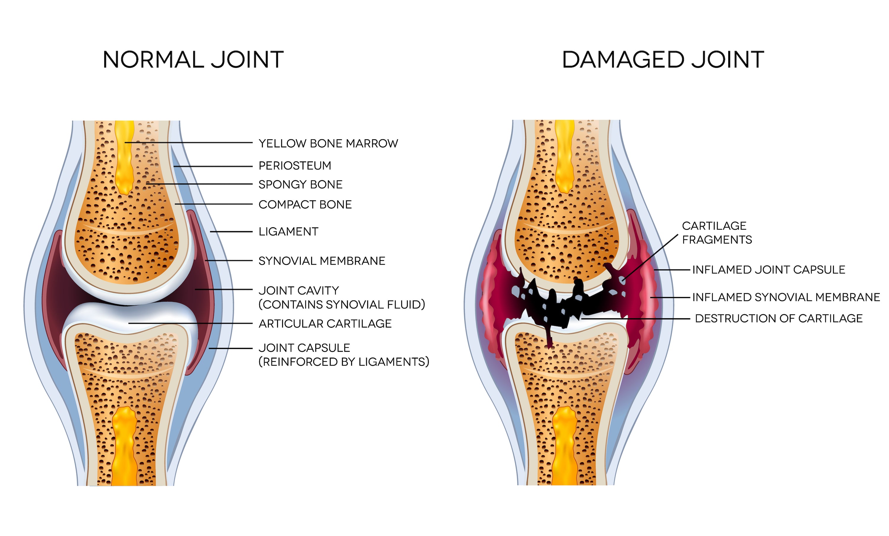 normal joint vs damaged joint comparison