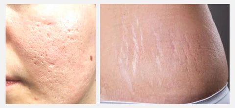 Exmaples of acne scars on the face and stretch marks (striae alba) on the flanks