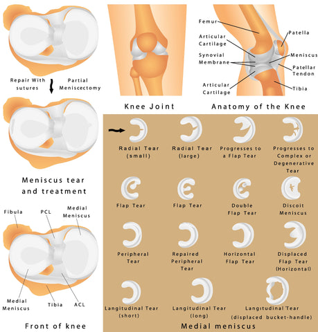 A graphic showing the types of meniscus tears and the meniscus tear knee support available!
