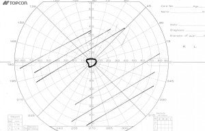 Goldmann visual fields - Item #103 with 10° visual field