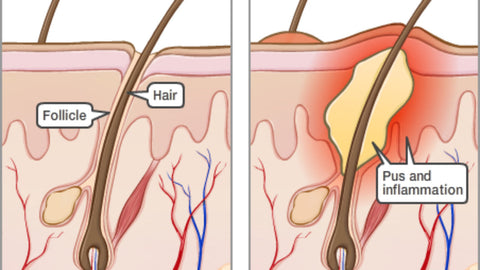 Scalp Inflammation