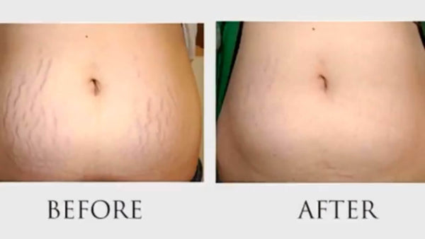 Argan oil for stretch marks, Before and after photo, Argan oil stretch mark cream, Best argan oil for skin, Best stretch mark cream for pregnancy, Best oil for stretch marks, Moroccan argan oil