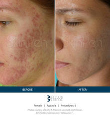 micro needling before and after