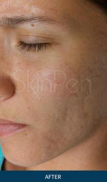 microneedling after picture