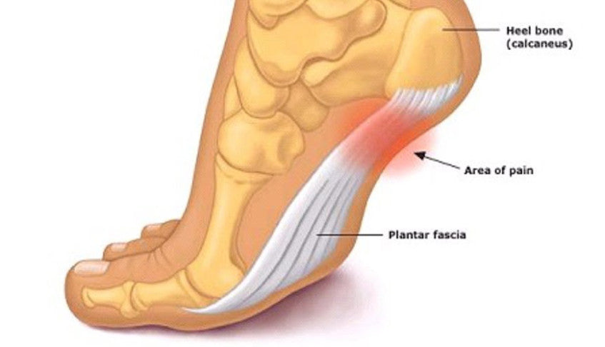 planters heel pain