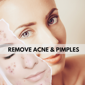 acne free skin